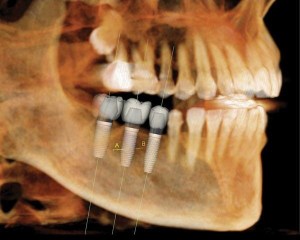 i-CAT teeth visualization